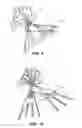 Fig. 06 - Methods and instruments for subchondral treatment of osteoarthritis in a small joint