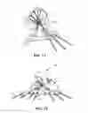 Fig. 07 - Methods and instruments for subchondral treatment of osteoarthritis in a small joint