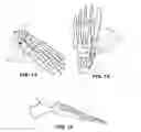 Fig. 08 - Methods and instruments for subchondral treatment of osteoarthritis in a small joint