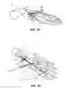 Fig. 10 - Methods and instruments for subchondral treatment of osteoarthritis in a small joint