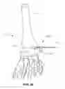 Fig. 13 - Methods and instruments for subchondral treatment of osteoarthritis in a small joint