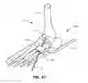Fig. 16 - Methods and instruments for subchondral treatment of osteoarthritis in a small joint