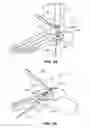 Fig. 20 - Methods and instruments for subchondral treatment of osteoarthritis in a small joint