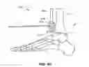 Fig. 23 - Methods and instruments for subchondral treatment of osteoarthritis in a small joint