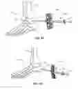 Fig. 24 - Methods and instruments for subchondral treatment of osteoarthritis in a small joint