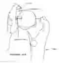 Fig. 01 - Method and apparatus for re-attaching the labrum to the acetabulum, including the provision and use of a novel suture anchor system