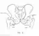 Fig. 03 - Method and apparatus for re-attaching the labrum to the acetabulum, including the provision and use of a novel suture anchor system