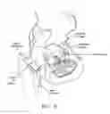 Fig. 10 - Method and apparatus for re-attaching the labrum to the acetabulum, including the provision and use of a novel suture anchor system