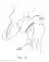 Fig. 11 - Method and apparatus for re-attaching the labrum to the acetabulum, including the provision and use of a novel suture anchor system