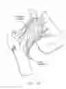 Fig. 12 - Method and apparatus for re-attaching the labrum to the acetabulum, including the provision and use of a novel suture anchor system
