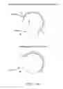Fig. 15 - Method and apparatus for re-attaching the labrum to the acetabulum, including the provision and use of a novel suture anchor system