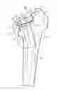 Fig. 01 - Patient-specific femoral version guide
