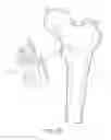 Fig. 04 - Patient-specific femoral version guide