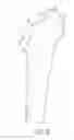 Fig. 05 - Patient-specific femoral version guide