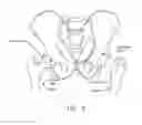 Fig. 03 - Method and apparatus for accessing the interior of a hip joint, including the provision and use of a novel telescoping access cannula and a novel telescoping obturator