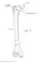 Fig. 04 - Method and apparatus for accessing the interior of a hip joint, including the provision and use of a novel telescoping access cannula and a novel telescoping obturator