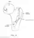 Fig. 05 - Method and apparatus for accessing the interior of a hip joint, including the provision and use of a novel telescoping access cannula and a novel telescoping obturator