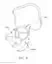 Fig. 06 - Method and apparatus for accessing the interior of a hip joint, including the provision and use of a novel telescoping access cannula and a novel telescoping obturator