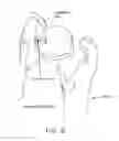 Fig. 09 - Method and apparatus for accessing the interior of a hip joint, including the provision and use of a novel telescoping access cannula and a novel telescoping obturator