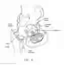 Fig. 10 - Method and apparatus for accessing the interior of a hip joint, including the provision and use of a novel telescoping access cannula and a novel telescoping obturator