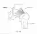 Fig. 13 - Method and apparatus for accessing the interior of a hip joint, including the provision and use of a novel telescoping access cannula and a novel telescoping obturator