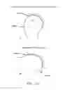 Fig. 14 - Method and apparatus for accessing the interior of a hip joint, including the provision and use of a novel telescoping access cannula and a novel telescoping obturator