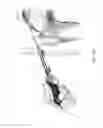 Fig. 28 - Method and apparatus for accessing the interior of a hip joint, including the provision and use of a novel telescoping access cannula and a novel telescoping obturator