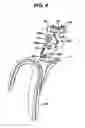 Fig. 05 - Surgical device with overload mechanism