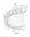 Fig. 14 - MOLDED DENTURE AND METHOD AND APPARATUS OF MAKING SAME