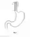 Fig. 02 - Esophageal sleeve