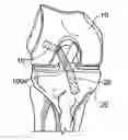 Fig. 01 - METHODS AND SYSTEMS FOR FORMING UNICOMPARTMENTAL AND UNICONDYLAR KNEE RESURFACING IN CONJUNCTION WITH CRUCIATE LIGAMENT REPLACEMENT CONCOMITANTLY