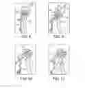 Fig. 04 - METHODS AND SYSTEMS FOR FORMING UNICOMPARTMENTAL AND UNICONDYLAR KNEE RESURFACING IN CONJUNCTION WITH CRUCIATE LIGAMENT REPLACEMENT CONCOMITANTLY