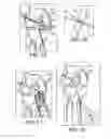 Fig. 06 - METHODS AND SYSTEMS FOR FORMING UNICOMPARTMENTAL AND UNICONDYLAR KNEE RESURFACING IN CONJUNCTION WITH CRUCIATE LIGAMENT REPLACEMENT CONCOMITANTLY
