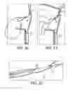 Fig. 09 - METHODS AND SYSTEMS FOR FORMING UNICOMPARTMENTAL AND UNICONDYLAR KNEE RESURFACING IN CONJUNCTION WITH CRUCIATE LIGAMENT REPLACEMENT CONCOMITANTLY