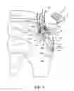 Fig. 05 - Muscle tissue anchor plate
