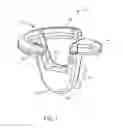 Fig. 02 - GRAFT FIXATION