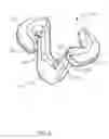 Fig. 05 - GRAFT FIXATION