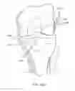 Fig. 36 - GRAFT FIXATION