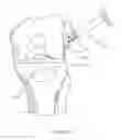 Fig. 38 - GRAFT FIXATION
