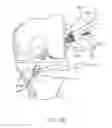 Fig. 40 - GRAFT FIXATION
