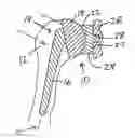 Fig. 01 - Method for optimization of joint arthroplasty component design