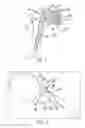 Fig. 02 - Method for optimization of joint arthroplasty component design