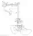 Fig. 01 - ACETABULAR EXPLANT APPARATUS, SYSTEM, AND METHOD