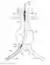 Fig. 01 - Bifurcated endovascular prosthesis having tethered contralateral leg