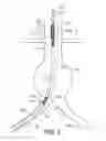 Fig. 03 - Bifurcated endovascular prosthesis having tethered contralateral leg