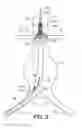 Fig. 04 - Bifurcated endovascular prosthesis having tethered contralateral leg