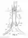 Fig. 05 - Bifurcated endovascular prosthesis having tethered contralateral leg