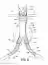 Fig. 06 - Bifurcated endovascular prosthesis having tethered contralateral leg