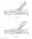Fig. 07 - Multi-stent and multi-balloon apparatus for treating bifurcations and methods of use