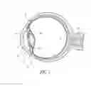 Fig. 02 - Ocular system with anchoring implant and therapeutic agent